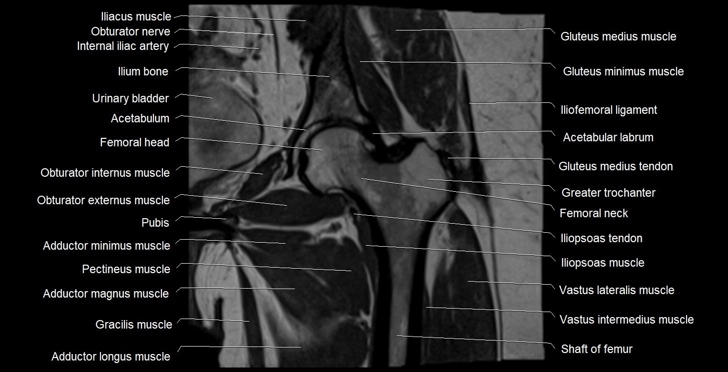 MRI Hip 3T coronal cross sectional anatomy image 32.webp